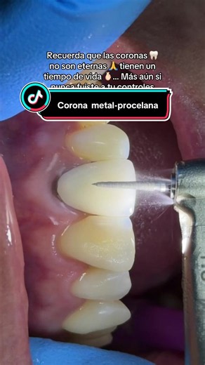 Corona de metal porcelana #corona #coronadental #crown #endodoncia #dentist