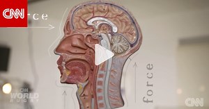 ما هو ارتجاج الدماغ؟