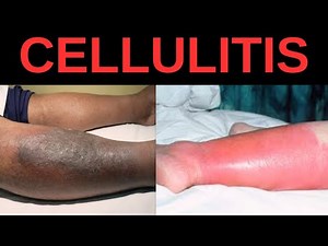 What is Cellulitis? Symptoms, Causes, Treatment