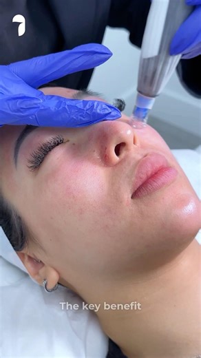 Part 2- The Vampire Facial: PRP Microneedling Benefits And Risks