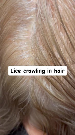 7.8K views · 25 reactions | Lice crawling in hair l lice services #lice #momlife #hair #explore #smallbusiness | Stacey The Louse Lady | Facebook