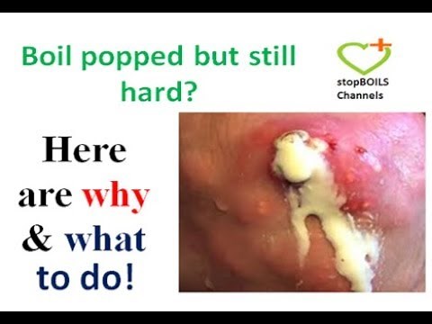 How to heal a boil popped but still hard , what you can do to heal boil thoroughly