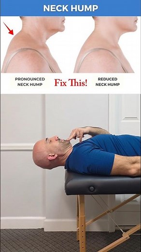 How to Fix a Neck Hump at Home (Fast)