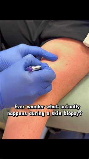 Skin biopsy procedure in clinic: step-by-step overview including marking, local anesthesia, tissue sampling, hemostasis, and wound care #dermatology * #skincareeducation * #medicaltiktok * #nursepractitioner * #skinbiopsy