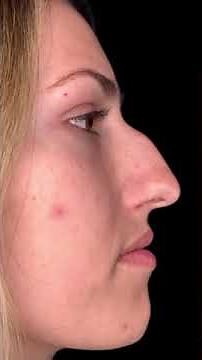 Aspectos importantes de la giba o dorso nasal en Rinoplastia