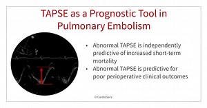 TAPSE as a Prognostic Tool in Pulmonary Embolism