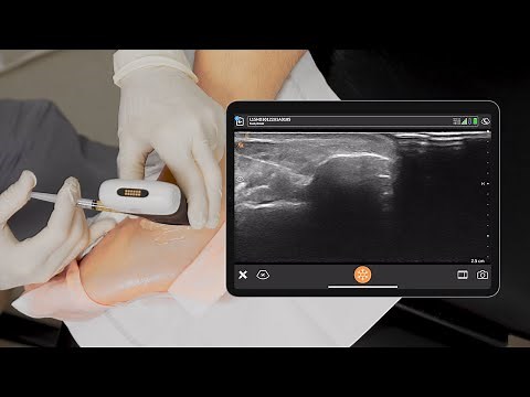 PRP Ankle Injections