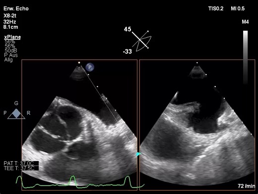 🔍A 79-year-old AF patient with prior CABG and LAA closure using an AtriClip now presents with recurrent GI bleeding and epistaxis. He’s on reduced-dose Apixaban, but TEE shows incomplete LAA closure. ➡️ High thromboembolic (CHA₂DS₂-VASc 5) and bleeding risk (HAS-BLED 5). Would you stop anticoagulation? Part 1 of this new read & share case submitted by challenges the decision-making at this intersection of risks. 📖 Read Part 1 now: bit.ly/3FTwjPh | PCRonline