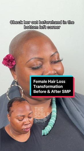 Scalp Micropigmentation NYC: Hair Loss Transformation