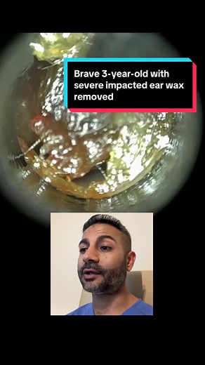 Brave 3-Year-Old's Ear Wax Removal with WAXscope®