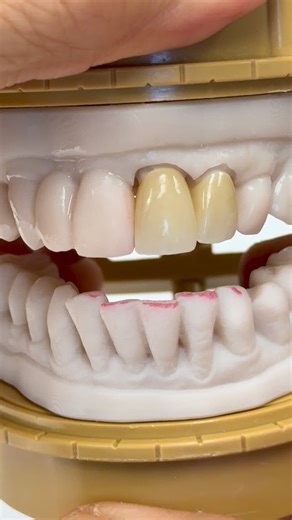 Two Monet pure zirconia ceramics! Dr.Andre Jones in Texas | CEO Luke Kahng