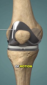 7K views · 55 reactions | Total Knee Replacement Surgery (3D Animation) #kneereplacement #kneereplacementsurgery #totalkneereplacement #kneearthritis #kneejoint #kneetransplant #kneetransplantsurgery #medical3danimation #3dmedicalanimation | Surgery Page | Facebook