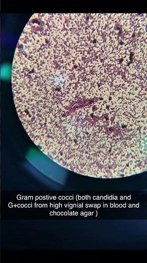 (Gram stain)Bacteria (G+cocci) and fungi (candida) under microscope.