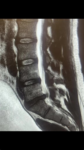 L5 S1 Herniated Disc Recovery Journey