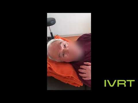 Supine Roll Test - Positional Vertigo in the Lateral Semicircular Canal (Canalolithiasis)