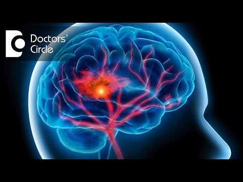 What is Mini Stroke & its symptoms? - Dr. Tejus MN Rao