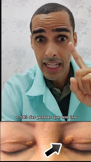 this sign in the eyes reveals HIGH CHOLESTEROL