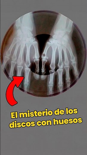 ¿Qué son los discos-hueso?