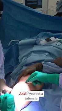 Right Distal Tibial Oblique Fracture Open Reduction and Internal Fixation (ORIF) #doctor #medical