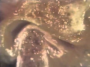 TMJ Disorder: Displaced Disc without Reduction