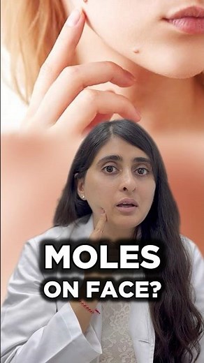 How to get rid of moles on skin | How to remove moles on face | Moles treatment dermatologist