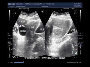A large Fibroid and two ovarian Cysts.