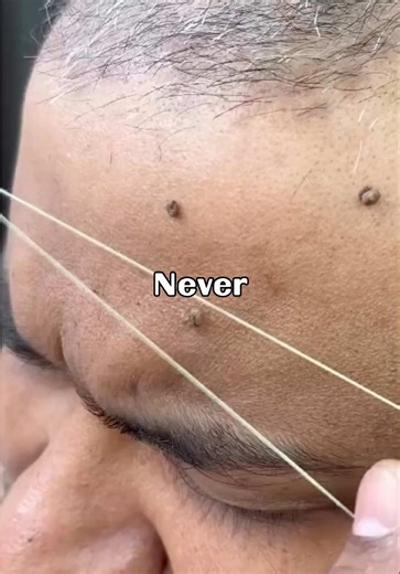 Risks of At-Home Wart Removal Techniques