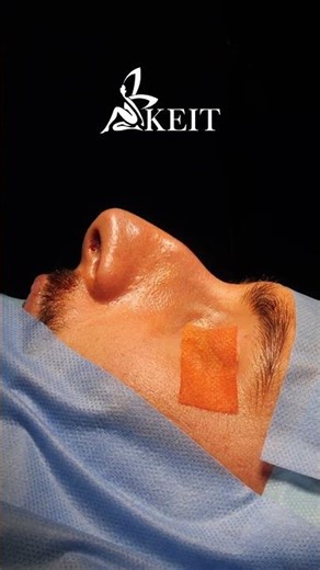 Male Rhinoplasty Transformation | Real Patient Before and After Results