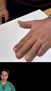 The silicone prosthetic fingers seen here are truly works of art. Although they don't necessarily improve function, they certainly can help with cosmetics. I'm very impressed by the ones in this video, as they are quite realistic. Be sure to check out @siliconeworldorthopedic for more excellent prosthetic work. Original video credit: @siliconeworldorthopedic #prosthetic #silicone #amputation #prosthetics | Nick Pappas, MD