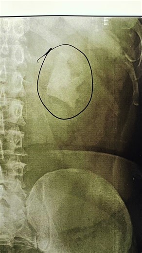 Successful PCNL Surgery for Staghorn Renal Stone