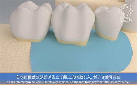 牙周手术治疗（牙周再生治疗）