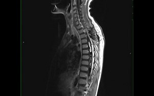 122 （脊髓室管膜瘤）Spinal Cord Ependymoma