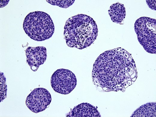 First patient-derived organoid model for cervical cancer
