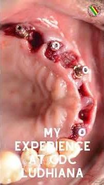 Listen to our patient who received implants to restore function, confidence, and quality of life.