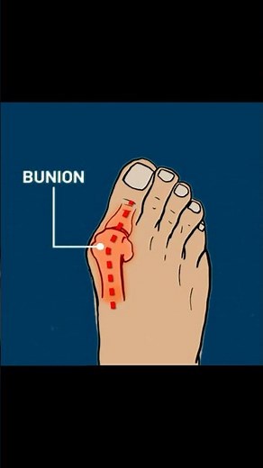 What Is Hallux Valgus (Bunion)? Explained Fast! #anatomy #physiotherapy