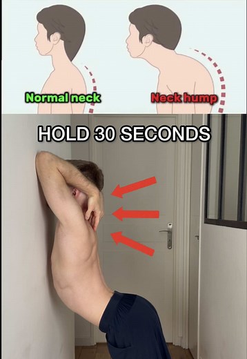 Neck Hump Exercises: Get Rid of Neck Hump in 7 Days