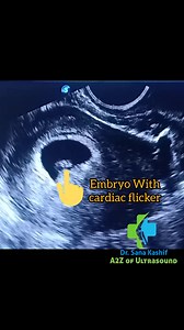 1.1K reactions · 38 shares | Early pregnancy, First Trimester Scan #ultrasoundlearning #UltrasoundEducation #asar #Radiology #ultrasoundcases #radiologylife #FRCR #SCFHS #FWB #CRL #gestational #sac #yolksac | Sana Kashif | Facebook