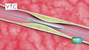 When you have questions, News 12 has Expert Answers! Dr. Chris LeSar with the Vascular Institute of Chattanooga explains May-Thurner Syndrome and how it affects patients. | WDEF News 12