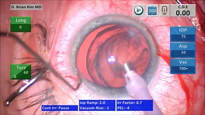 Surgical Pearls on How to Handle Ectopia Lentis: Lens Removal, IOL, CTR, Sutured CTS - Eyetube