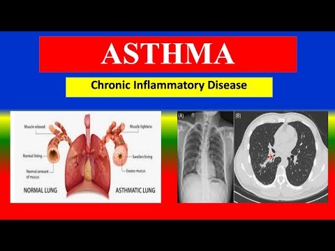 ASTHMA - Definition, types, cusses, risk factor, sign and symptom, diagnoses, treatment - lecture