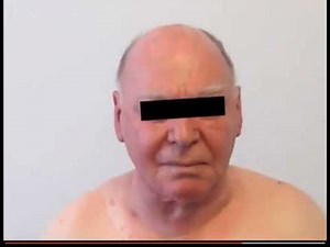 Retrostenal Goiter Pemberton's sign