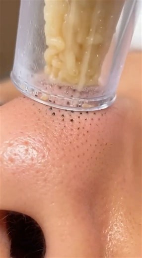 Satisfying Blackhead & Sebum Plug Extraction | Hydro-Vacuum Deep Pore Cleansing