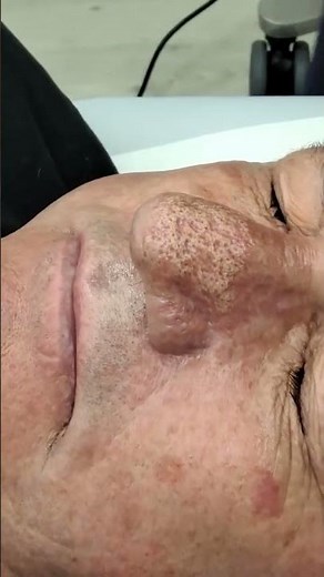 Rhinophyma treatment Neogen Plasma #Rhinophyma