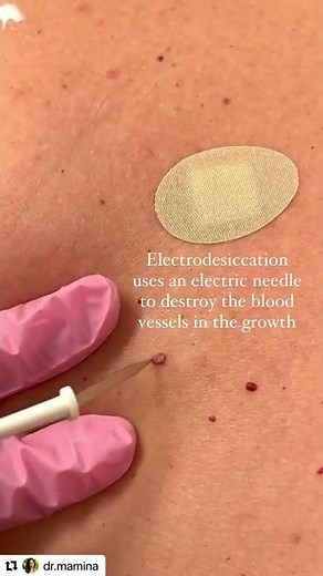 Burning a Cherry Angioma 🍒
