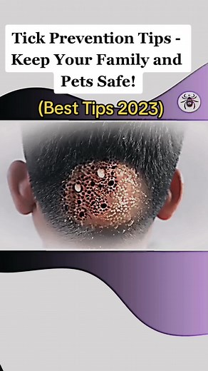 TickTok | Tick Prevention on TikTok