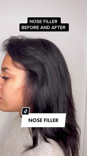 NOSE FILLER BEFORE AND AFTER #nosefiller #nosefillercheck #nosefillerlondon #nosefilleruk #nosefillerbeforeandafters #nonsurgicalrhinoplasty #nonsurgicalnosejob #nosejob #nosejobcheck