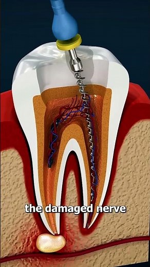 Root Canal Treatment Explained | 3D Dental Animation