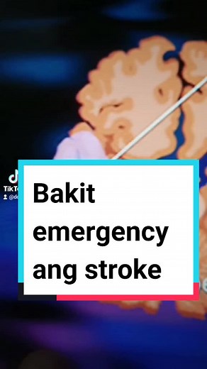Reply to @dlester45 Kung bakit EMERGENCY ang STROKE. Para magawa ang reperfusion treatment. #timeisbrain #docN #stroke #healthtokph