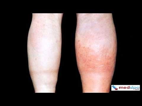 D Dimer Blood Test - Normal Range, Result Interpretation, Risks