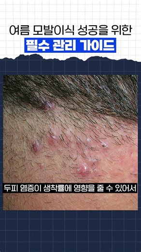 여름 모발이식 성공을 위한 필수 관리 가이드 #모모성형외과 #김승준대표원장